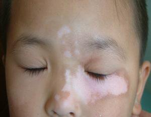 北京治疗白癜风最好的医院：儿童得了白癜风该怎么护理