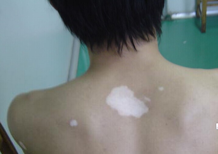 北京治疗白癜风最好的医院：背部白癜风会有什么危害
